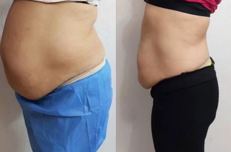 تزریق مانجارو در اصفهان