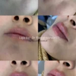 تزریق فیلر در اصفهان