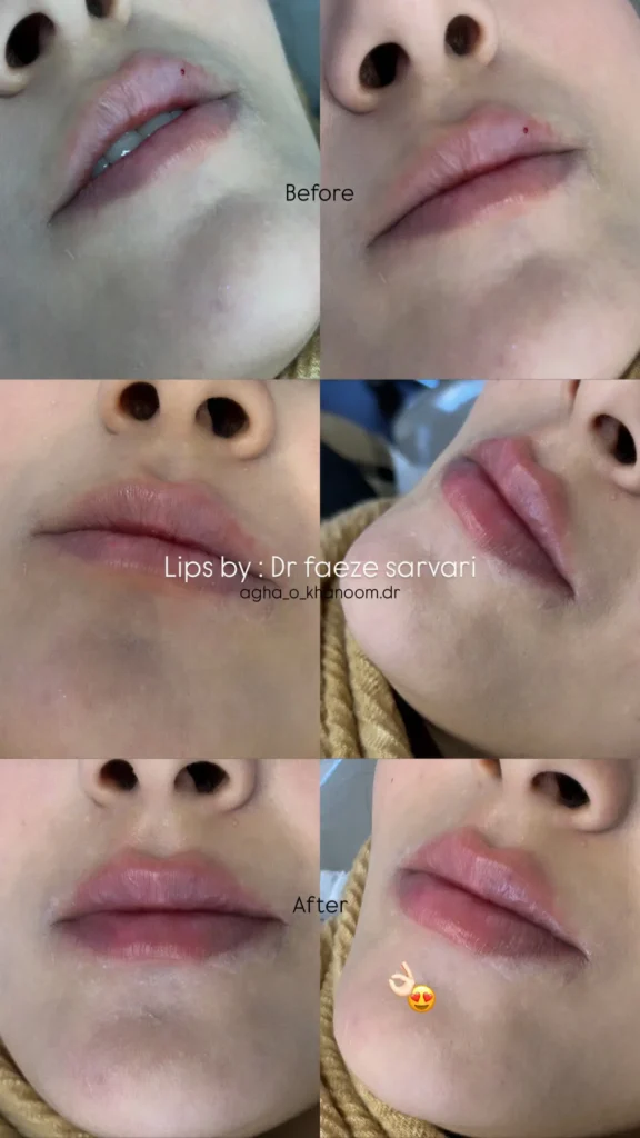 تزریق فیلر در اصفهان