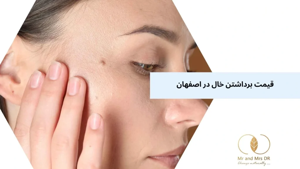 قیمت برداشتن خال در اصفهان