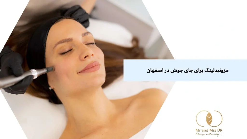 مزونیدلینگ برای جای جوش در اصفهان