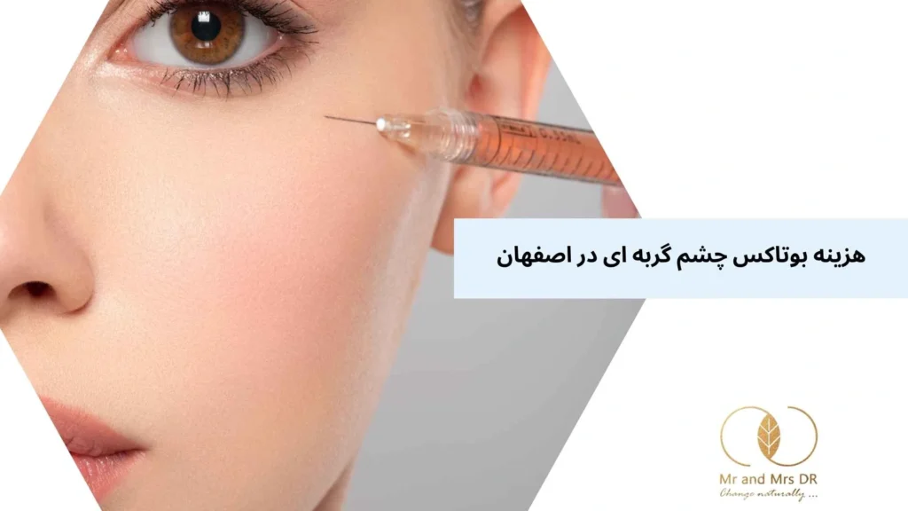 هزینه بوتاکس چشم گربه ای در اصفهان
