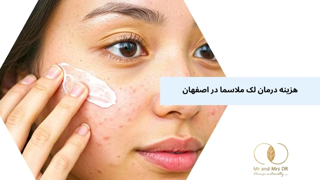 هزینه درمان لک ملاسما در اصفهان