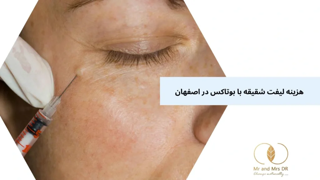 هزینه لیفت شقیقه با بوتاکس در اصفهان
