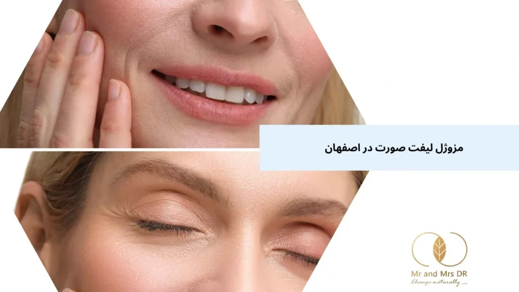 مزوژل لیفت صورت در اصفهان