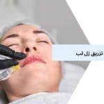 انواع مدل تزریق ژل لب