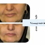 تزریق فیلر خط خنده چیست؟