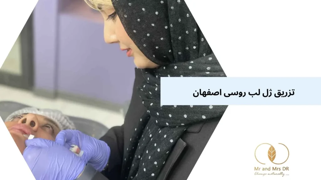 تزریق ژل لب روسی اصفهان
