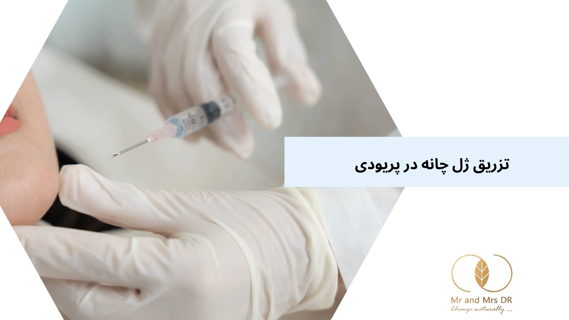 تزریق ژل چانه در پریودی