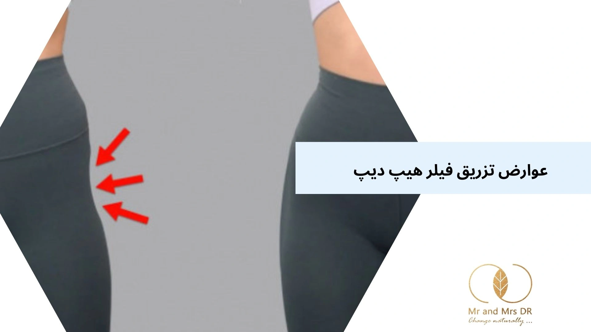 عوارض تزریق فیلر هیپ دیپ 