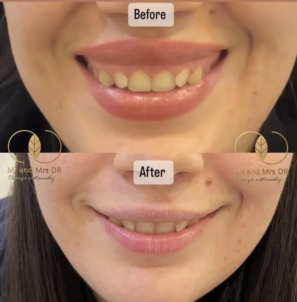 عکس قبل و بعد بوتاکس لب در اصفهان