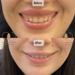 عکس قبل و بعد بوتاکس لب در اصفهان