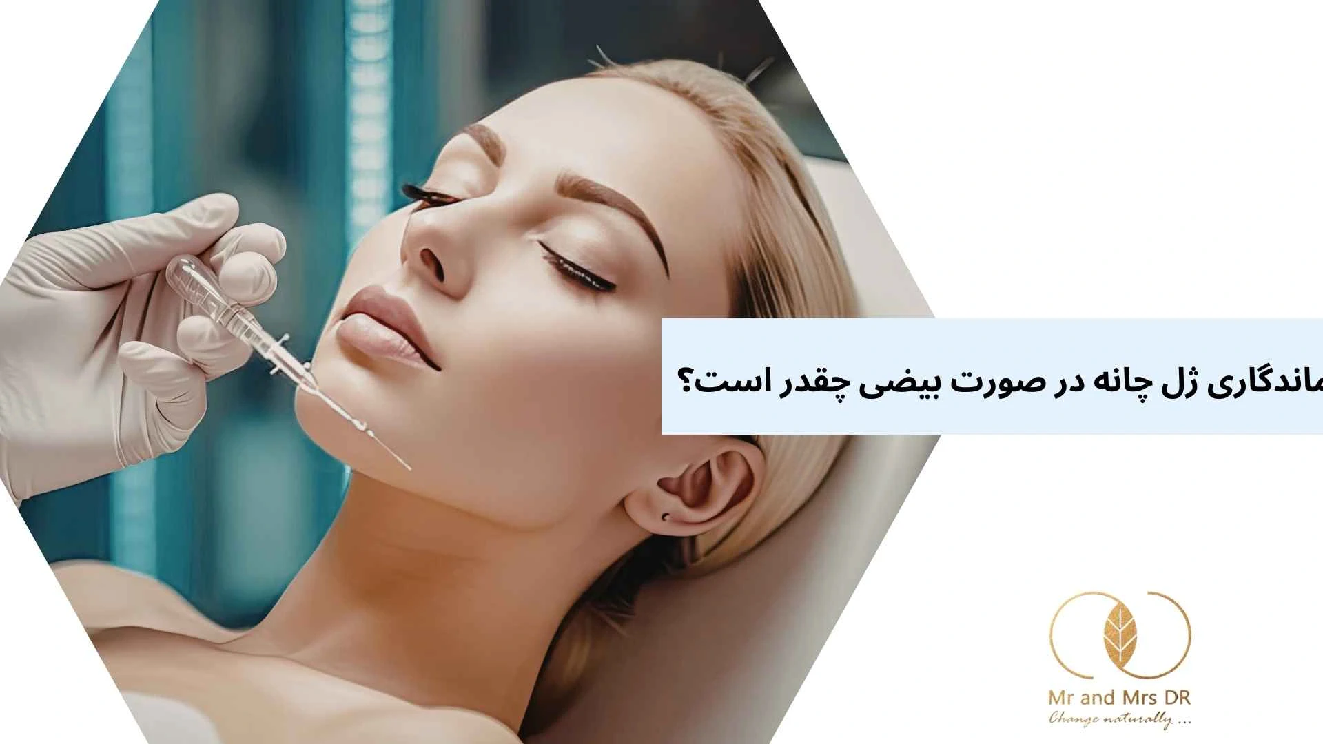 ماندگاری ژل چانه در صورت بیضی چقدر است؟