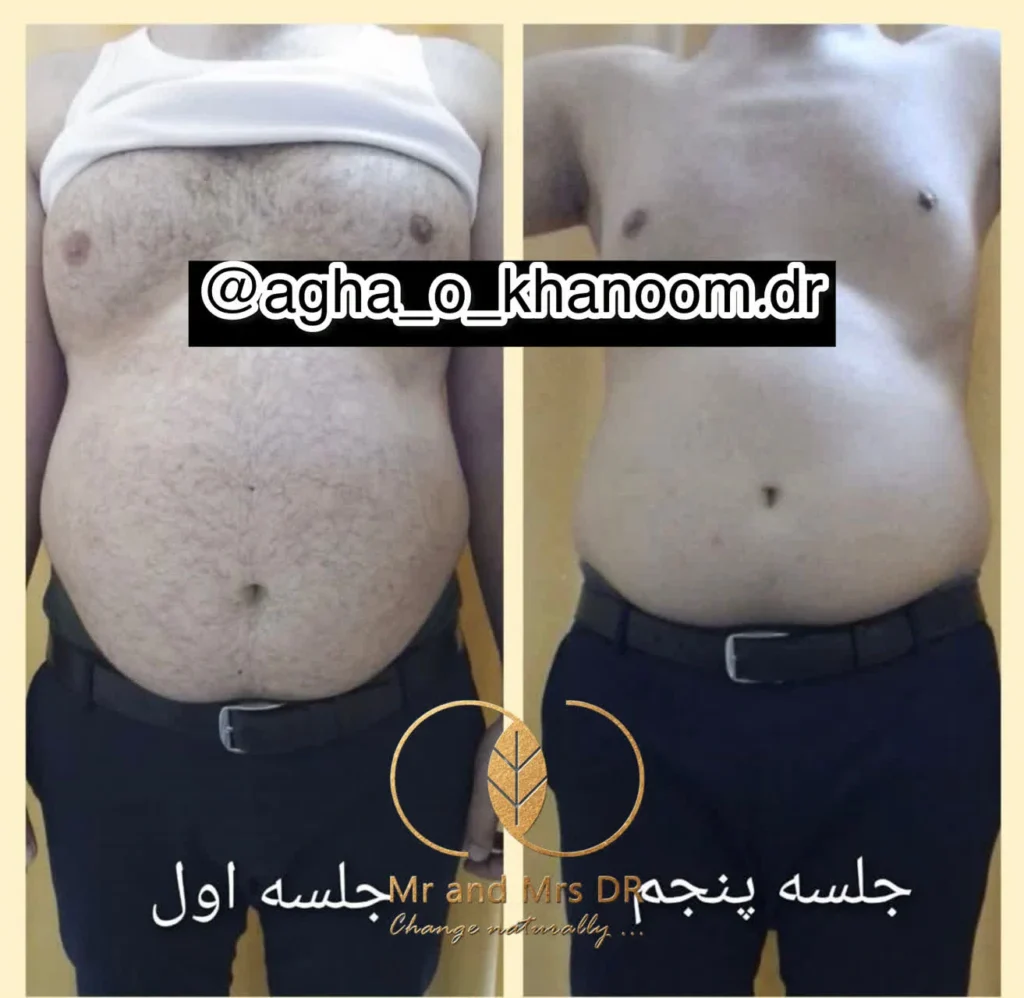نمونه کار تزریق آمپول اسپارتینا در اصفهان