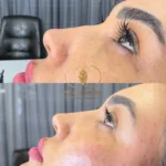 نمونه کار تزریق فیلر بینی در اصفهان