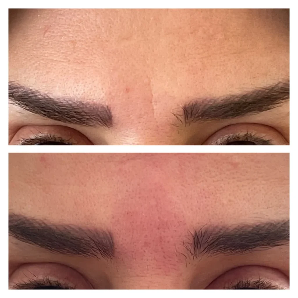 نمونه کار تزریق فیلر خط اخم در اصفهان