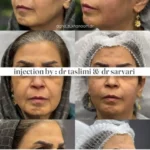 نمونه کار تزریق فیلر خط خنده در اصفهان