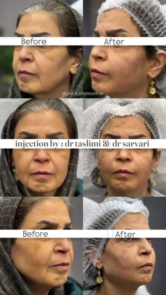 نمونه کار تزریق فیلر خط خنده در اصفهان