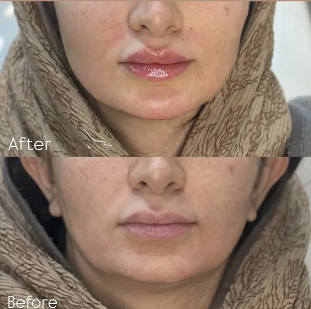 نمونه کار تزریق فیلر لب در اصفهان