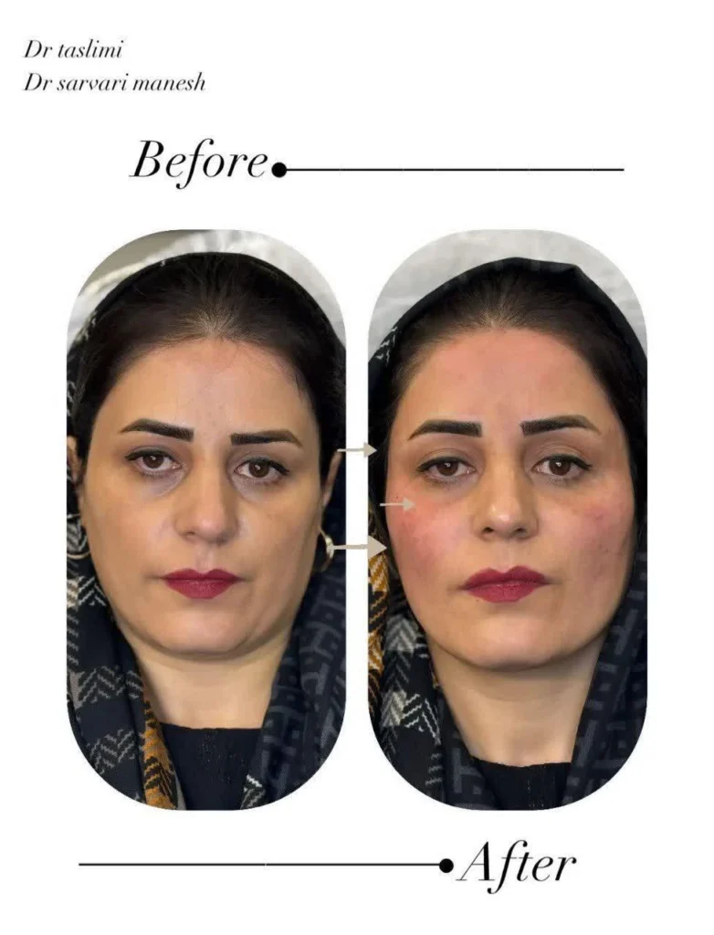 نمونه کار تزریق فیلر چشم در اصفهان