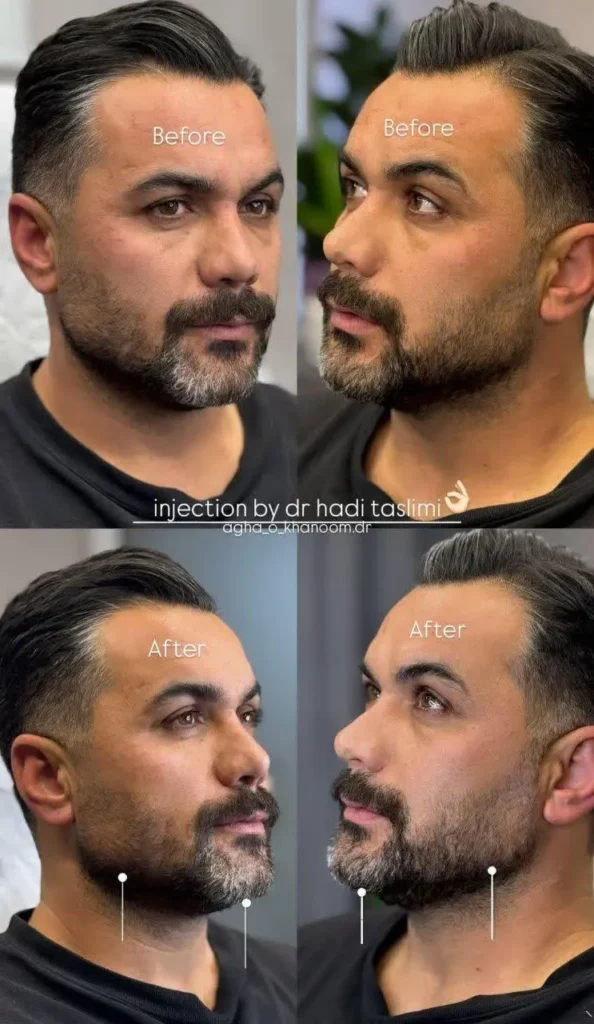 نمونه کار زاویه سازی صورت با فیلر در اصفهان