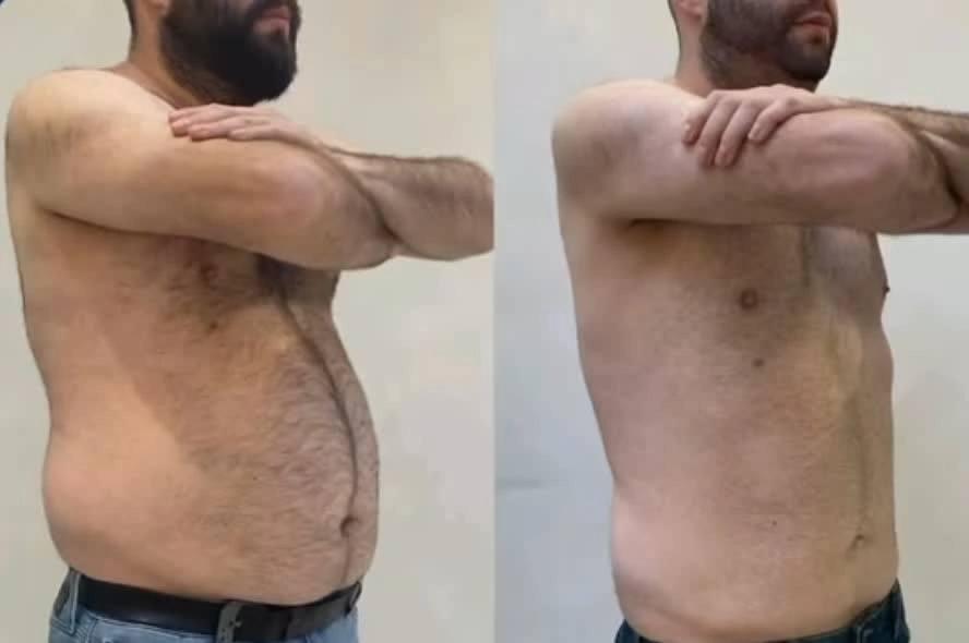 نمونه کار لاغری با دستگاه آر اف در اصفهان