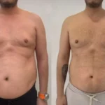 نمونه کار لاغری با رژیم و مکمل غذایی در اصفهان