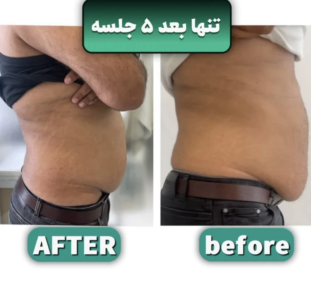 نمونه کار لاغری با کرایولیپولیز در اصفهان