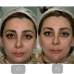 نمونه کار لیفت صورت با تزریق ژل در اصفهان