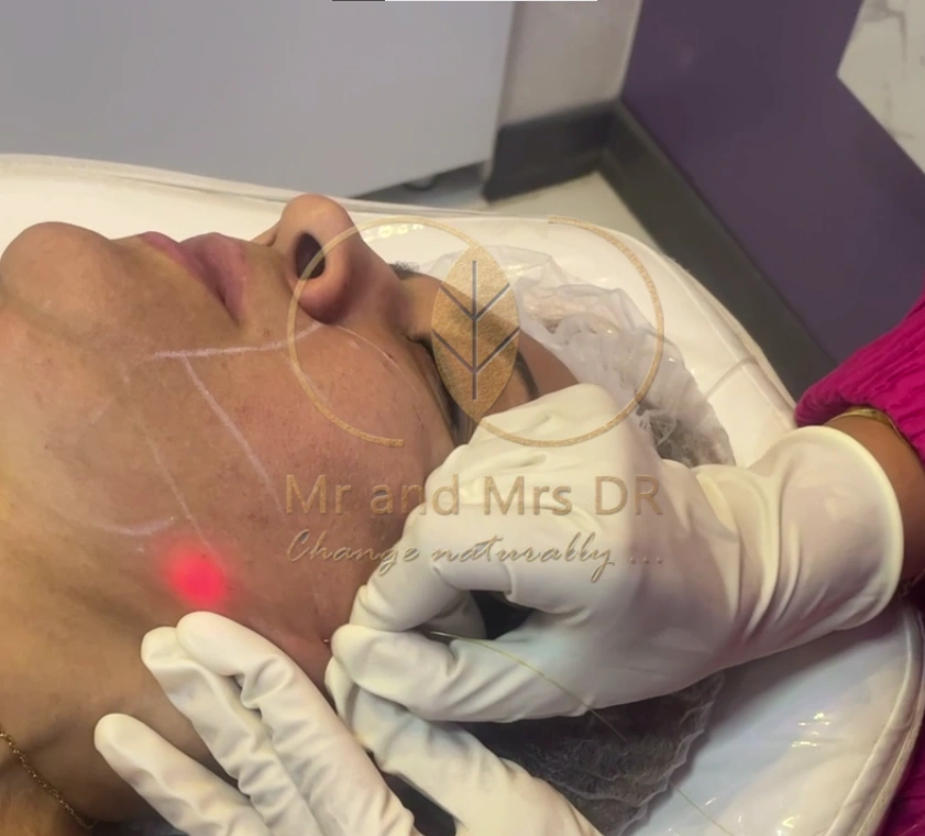 لیفت صورت با دستگاه اندولیفت در اصفهان