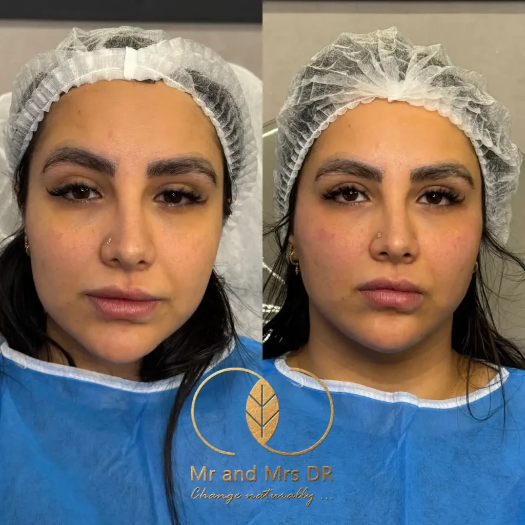 نمونه کار لیفت صورت با نخ لیفتینگ در اصفهان