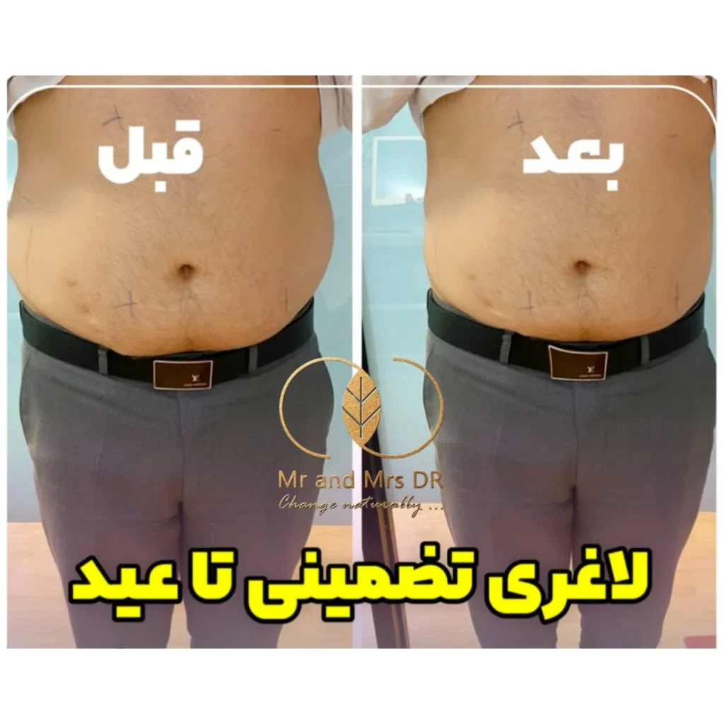 نمونه کار مزوتراپی لاغری در اصفهان