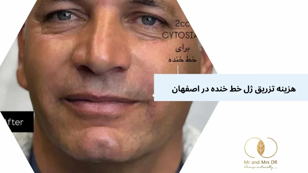هزینه تزریق ژل خط خنده در اصفهان