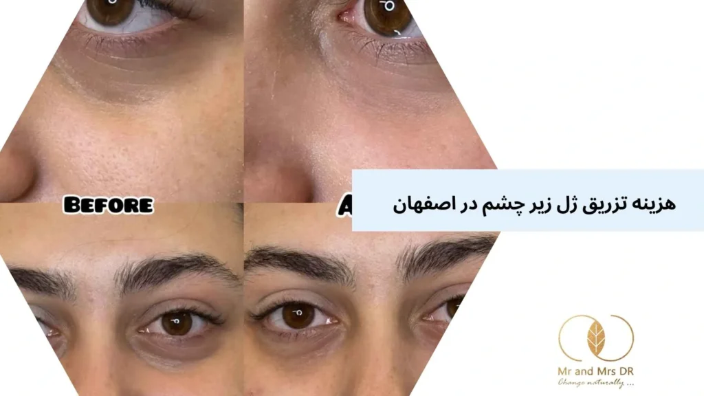 هزینه تزریق ژل زیر چشم در اصفهان