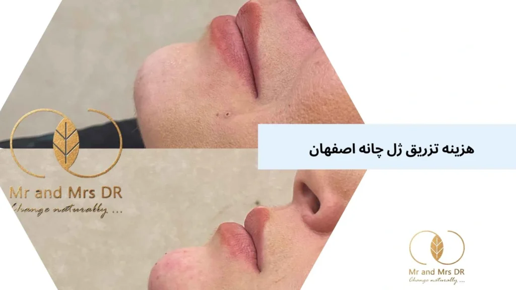 هزینه تزریق ژل چانه اصفهان