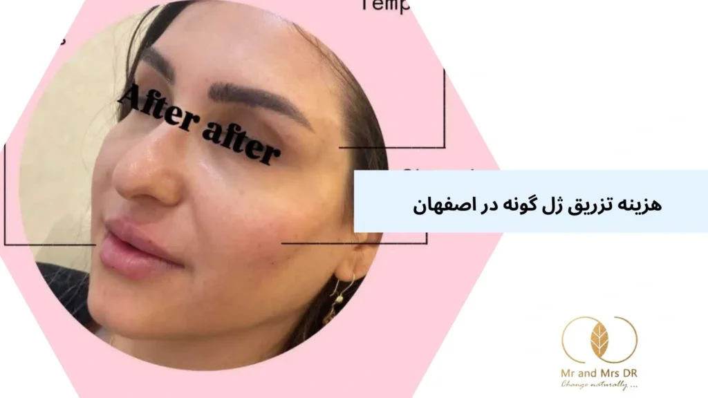 هزینه تزریق ژل گونه در اصفهان