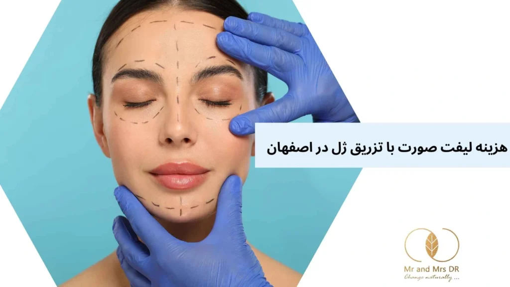 هزینه لیفت صورت با تزریق ژل در اصفهان