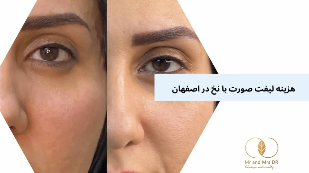 هزینه لیفت صورت با نخ در اصفهان